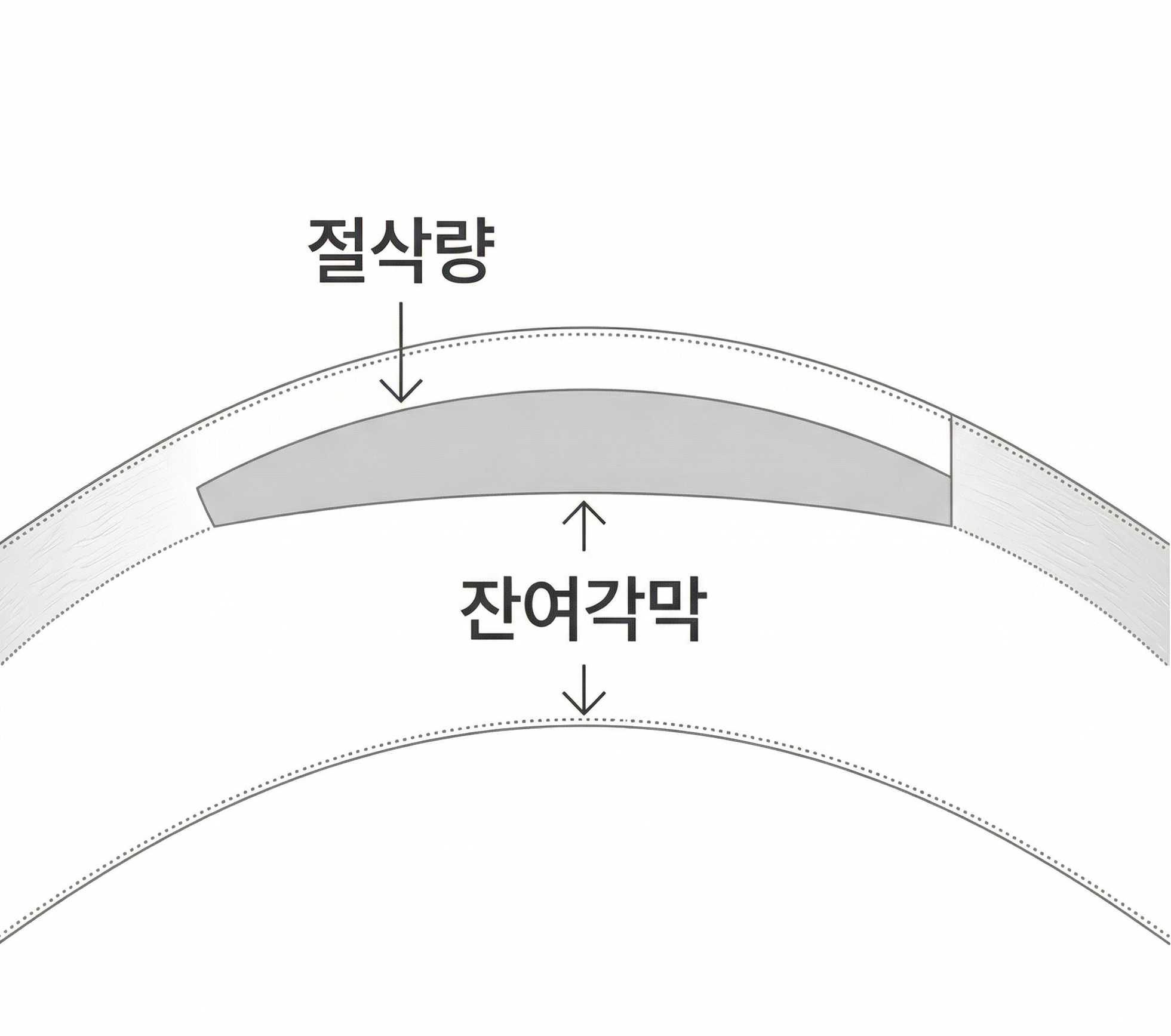 4세대 시력교정